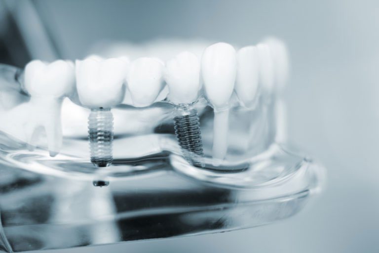 Sideview of dental implants